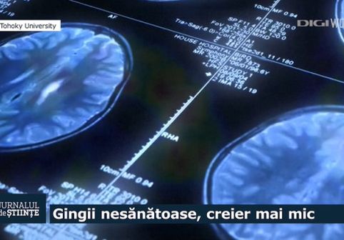 Legătura neașteptată dintre gingii și creier. Boala gingivală poate accelera îmbătrânirea unei zone esențiale