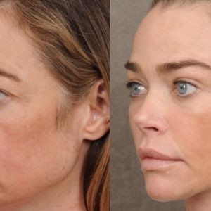 Denise Richards, de nerecunoscut după ce și-a făcut un lifting facial: „A fost cea mai bună decizie”